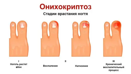 Stádia onychokryptózy při zarůstání nehtů