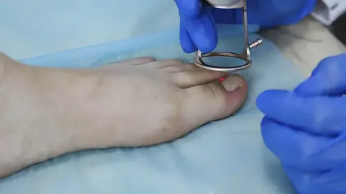 odstranění zarostlého nehtu